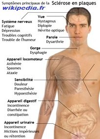 img-SEP-symptomes_sclerose_en_plaques