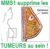img-cancer-sein-MMS1-jim-humble