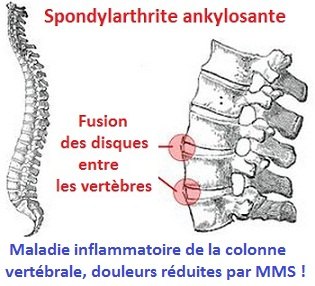 img-spondylarthrite-ankylosante